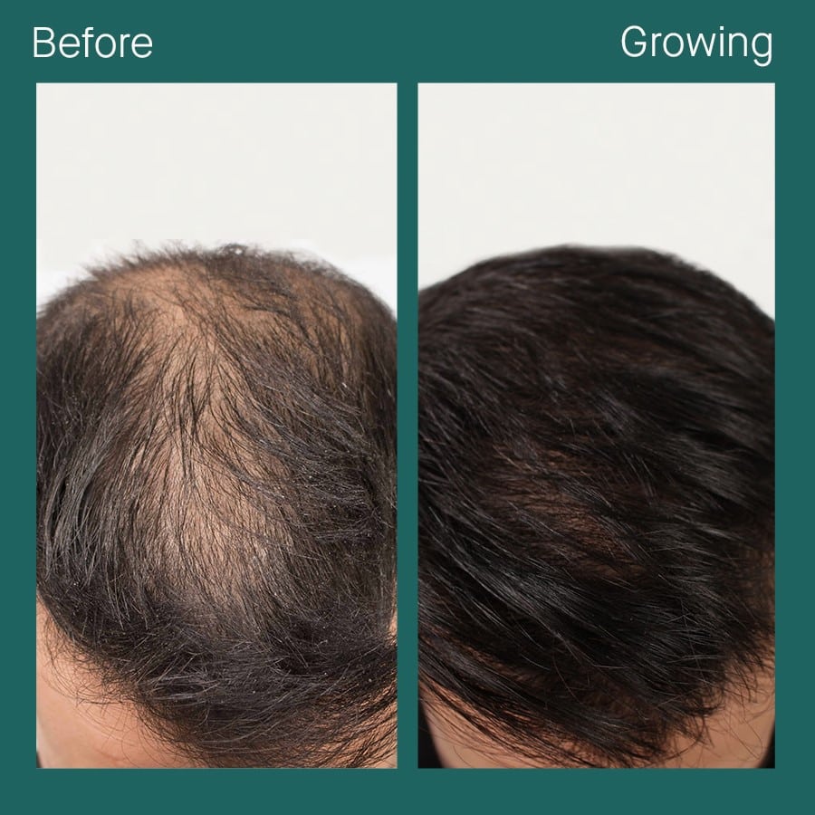 Nutrafol Before and After