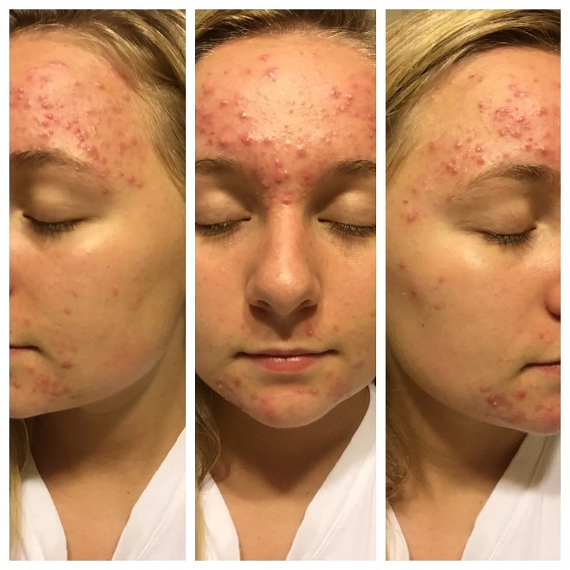 Tretinoin Before and After: A Comprehensive Analysis of its Effectiveness on Skin 2 Tretinoin Before and After: A Comprehensive Analysis of its Effectiveness on Skin