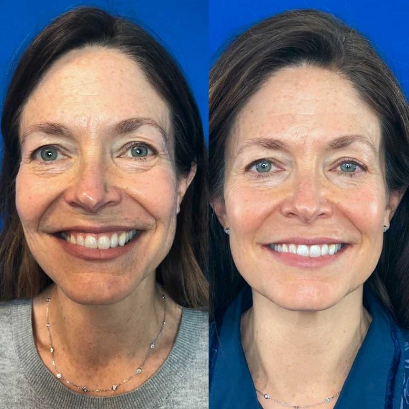 Tretinoin Before and After: A Comprehensive Analysis of its Effectiveness on Skin 11 Tretinoin Before and After: A Comprehensive Analysis of its Effectiveness on Skin