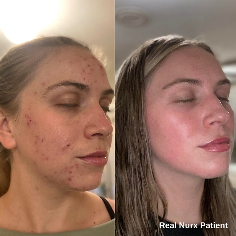Tretinoin Before and After: A Comprehensive Analysis of its Effectiveness on Skin 13 Tretinoin Before and After: A Comprehensive Analysis of its Effectiveness on Skin