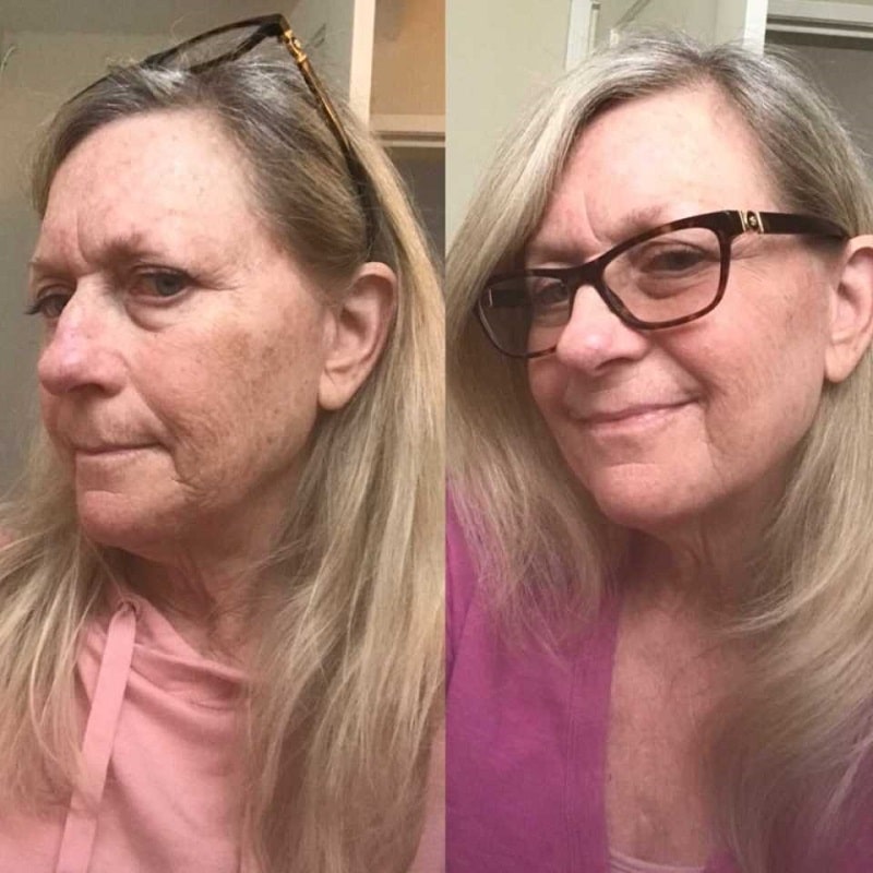 Tretinoin Before and After: A Comprehensive Analysis of its Effectiveness on Skin 15 Tretinoin Before and After: A Comprehensive Analysis of its Effectiveness on Skin