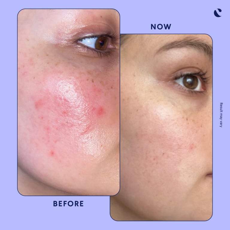 Tretinoin Before and After: A Comprehensive Analysis of its Effectiveness on Skin 16 Tretinoin Before and After: A Comprehensive Analysis of its Effectiveness on Skin