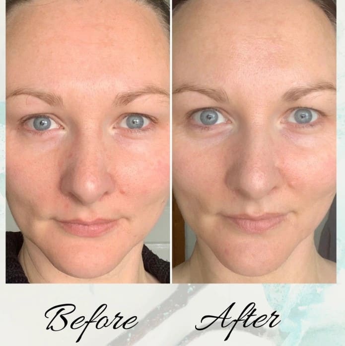 Tretinoin Before and After: A Comprehensive Analysis of its Effectiveness on Skin 17 Tretinoin Before and After: A Comprehensive Analysis of its Effectiveness on Skin