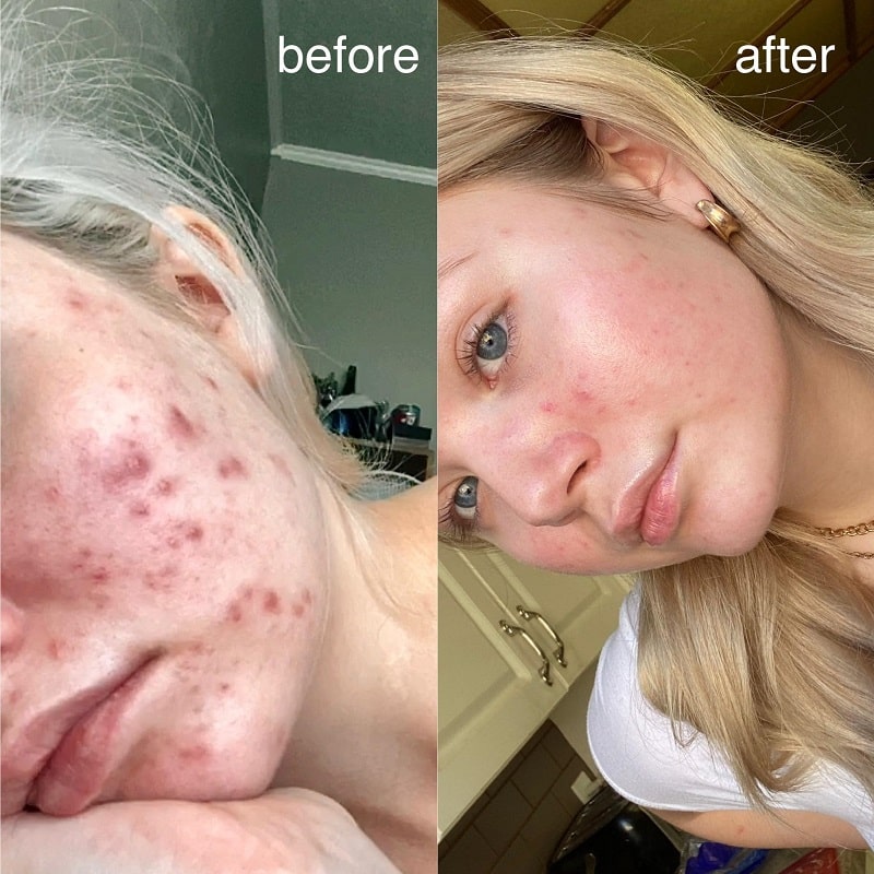 Tretinoin Before and After: A Comprehensive Analysis of its Effectiveness on Skin 19 Tretinoin Before and After: A Comprehensive Analysis of its Effectiveness on Skin