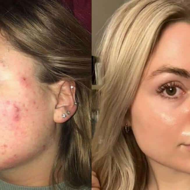 Tretinoin Before and After: A Comprehensive Analysis of its Effectiveness on Skin 20 Tretinoin Before and After: A Comprehensive Analysis of its Effectiveness on Skin