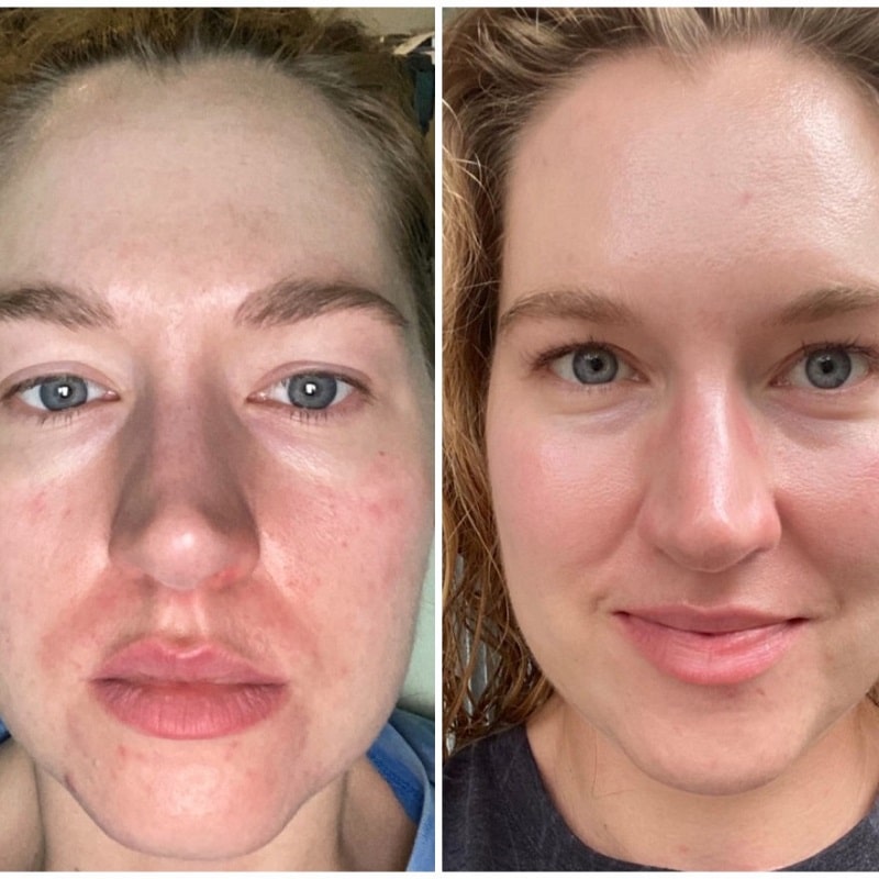 Tretinoin Before and After: A Comprehensive Analysis of its Effectiveness on Skin 3 Tretinoin Before and After: A Comprehensive Analysis of its Effectiveness on Skin
