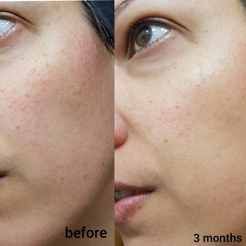 Tretinoin Before and After: A Comprehensive Analysis of its Effectiveness on Skin 21 Tretinoin Before and After: A Comprehensive Analysis of its Effectiveness on Skin