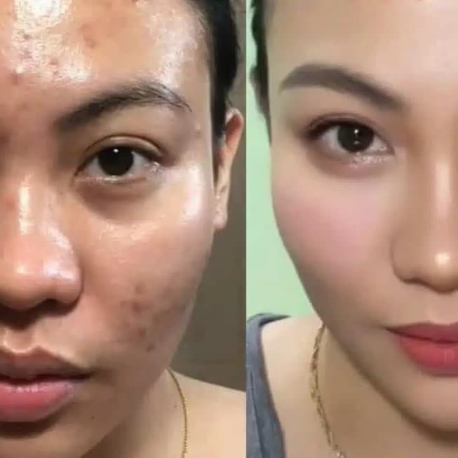Tretinoin Before and After: A Comprehensive Analysis of its Effectiveness on Skin 22 Tretinoin Before and After: A Comprehensive Analysis of its Effectiveness on Skin