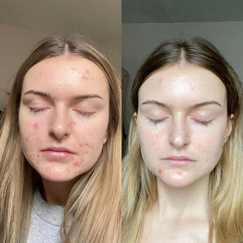 Tretinoin Before and After: A Comprehensive Analysis of its Effectiveness on Skin 23 Tretinoin Before and After: A Comprehensive Analysis of its Effectiveness on Skin