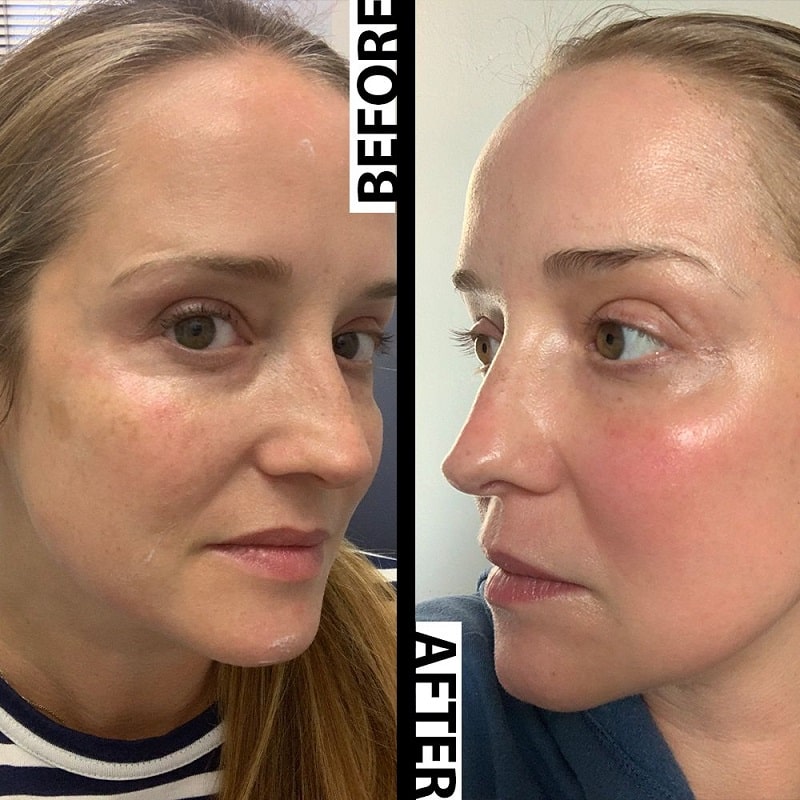 Tretinoin Before and After: A Comprehensive Analysis of its Effectiveness on Skin 24 Tretinoin Before and After: A Comprehensive Analysis of its Effectiveness on Skin