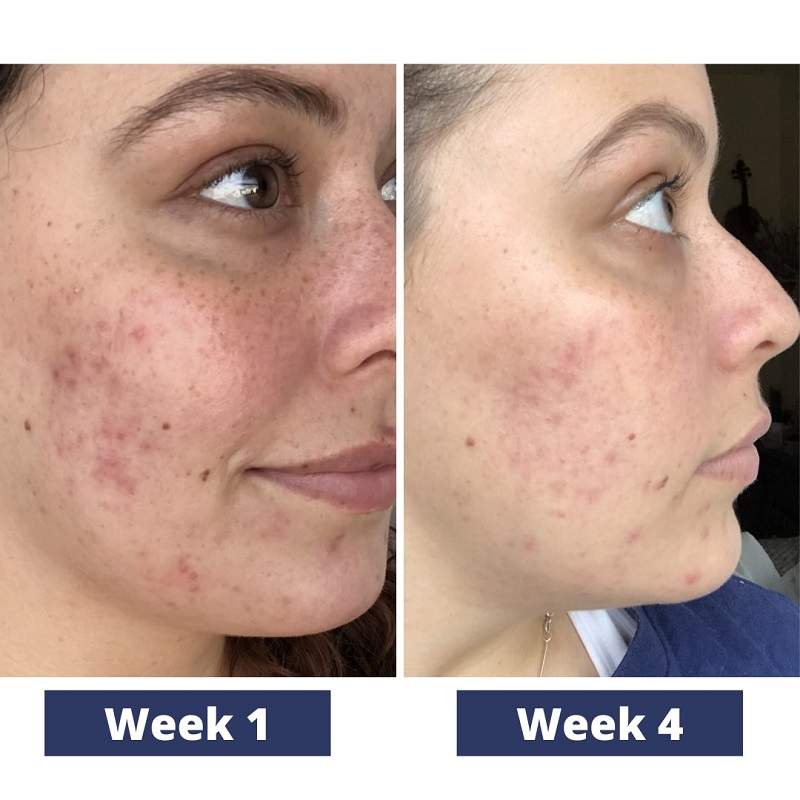Tretinoin Before and After: A Comprehensive Analysis of its Effectiveness on Skin 25 Tretinoin Before and After: A Comprehensive Analysis of its Effectiveness on Skin