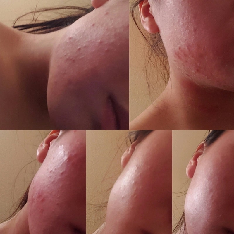Tretinoin Before and After: A Comprehensive Analysis of its Effectiveness on Skin 26 Tretinoin Before and After: A Comprehensive Analysis of its Effectiveness on Skin