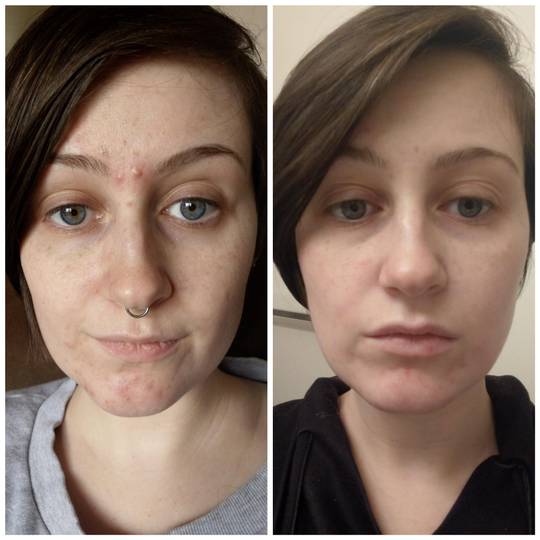 Tretinoin Before and After: A Comprehensive Analysis of its Effectiveness on Skin 27 Tretinoin Before and After: A Comprehensive Analysis of its Effectiveness on Skin