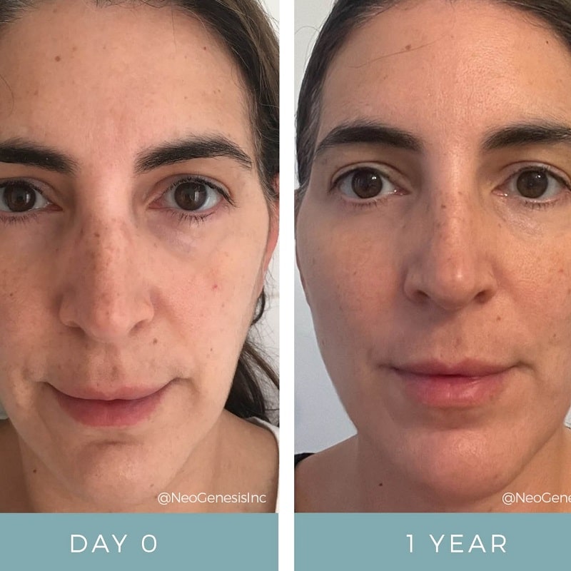 Tretinoin Before and After: A Comprehensive Analysis of its Effectiveness on Skin 28 Tretinoin Before and After: A Comprehensive Analysis of its Effectiveness on Skin