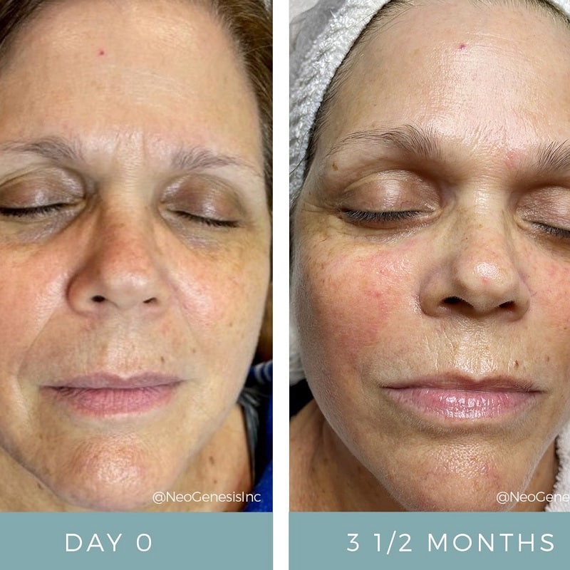 Tretinoin Before and After: A Comprehensive Analysis of its Effectiveness on Skin 29 Tretinoin Before and After: A Comprehensive Analysis of its Effectiveness on Skin