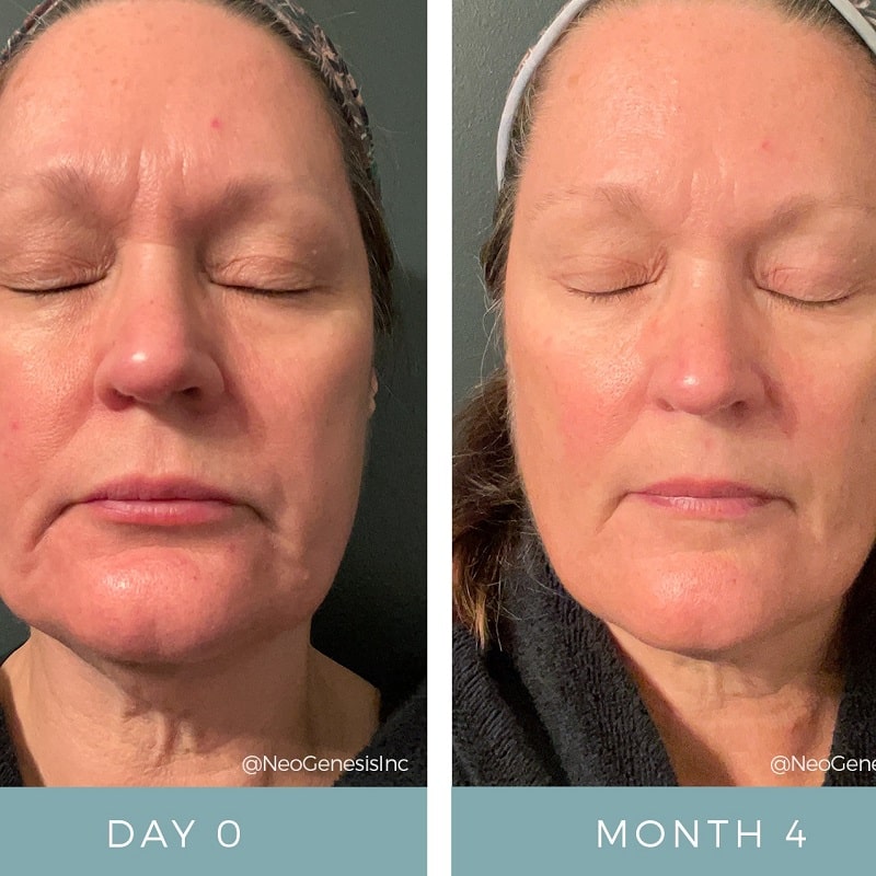Tretinoin Before and After: A Comprehensive Analysis of its Effectiveness on Skin 30 Tretinoin Before and After: A Comprehensive Analysis of its Effectiveness on Skin