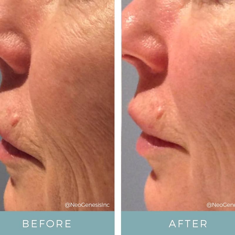 Tretinoin Before and After: A Comprehensive Analysis of its Effectiveness on Skin 31 Tretinoin Before and After: A Comprehensive Analysis of its Effectiveness on Skin
