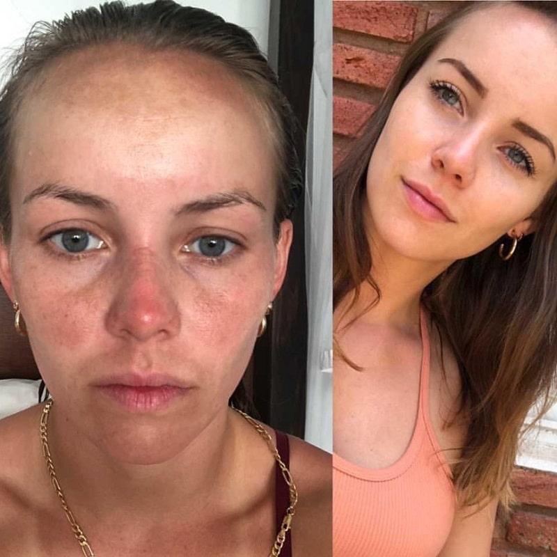Tretinoin Before and After: A Comprehensive Analysis of its Effectiveness on Skin 5 Tretinoin Before and After: A Comprehensive Analysis of its Effectiveness on Skin