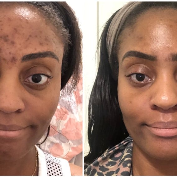 Tretinoin Before and After: A Comprehensive Analysis of its Effectiveness on Skin 6 Tretinoin Before and After: A Comprehensive Analysis of its Effectiveness on Skin