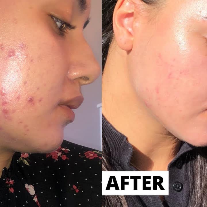 Tretinoin Before and After: A Comprehensive Analysis of its Effectiveness on Skin 7 Tretinoin Before and After: A Comprehensive Analysis of its Effectiveness on Skin
