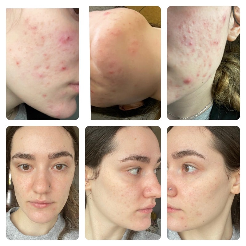 Tretinoin Before and After: A Comprehensive Analysis of its Effectiveness on Skin 8 Tretinoin Before and After: A Comprehensive Analysis of its Effectiveness on Skin