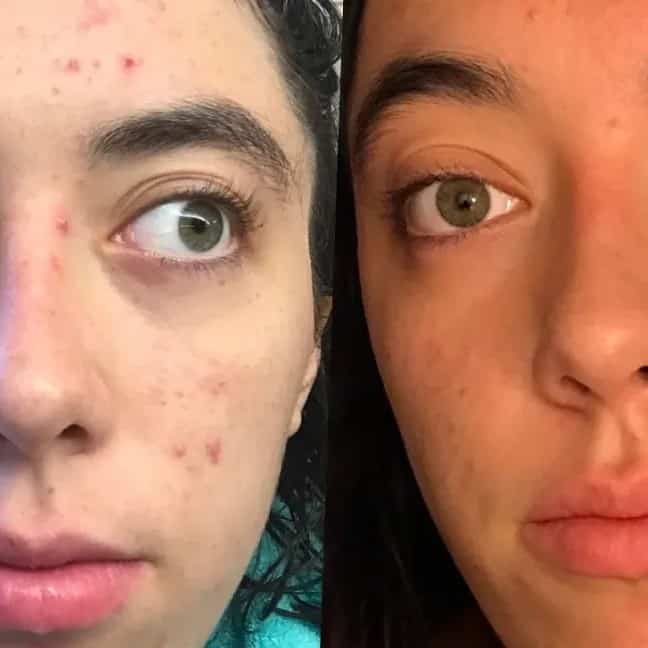 Tretinoin Before and After: A Comprehensive Analysis of its Effectiveness on Skin 9 Tretinoin Before and After: A Comprehensive Analysis of its Effectiveness on Skin