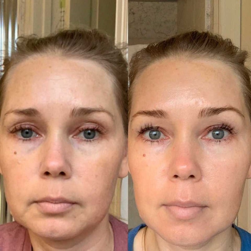 Tretinoin Before and After: A Comprehensive Analysis of its Effectiveness on Skin 10 Tretinoin Before and After: A Comprehensive Analysis of its Effectiveness on Skin