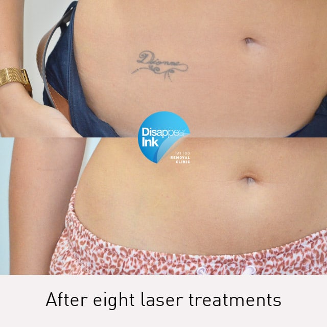 Tattoo Removal Before and After: What You Need to Know 14 Tattoo Removal Before and After: What You Need to Know