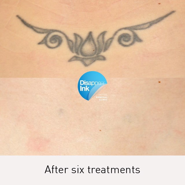 Tattoo Removal Before and After: What You Need to Know 15 Tattoo Removal Before and After: What You Need to Know