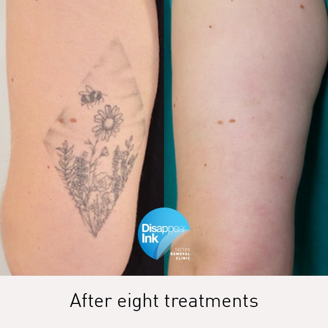 Tattoo Removal Before and After: What You Need to Know 18 Tattoo Removal Before and After: What You Need to Know
