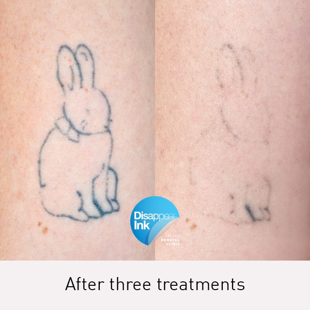Tattoo Removal Before and After: What You Need to Know 20 Tattoo Removal Before and After: What You Need to Know