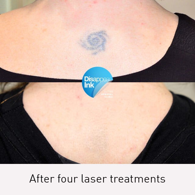 Tattoo Removal Before and After: What You Need to Know 3 Tattoo Removal Before and After: What You Need to Know