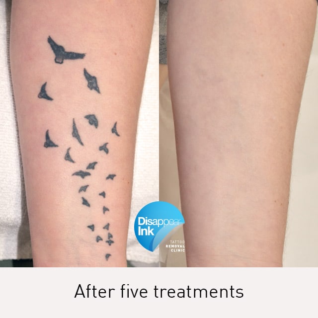 Tattoo Removal Before and After: What You Need to Know 23 Tattoo Removal Before and After: What You Need to Know