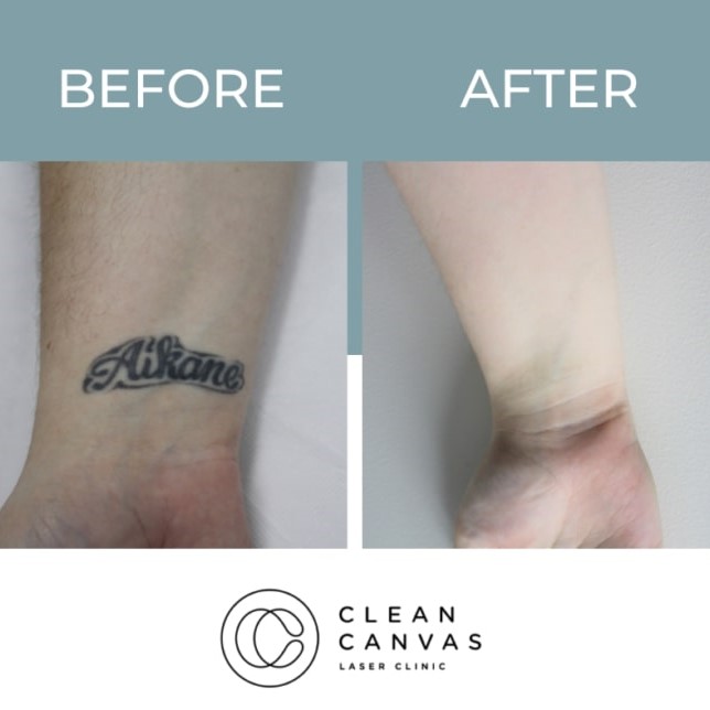 Tattoo Removal Before and After: What You Need to Know 24 Tattoo Removal Before and After: What You Need to Know