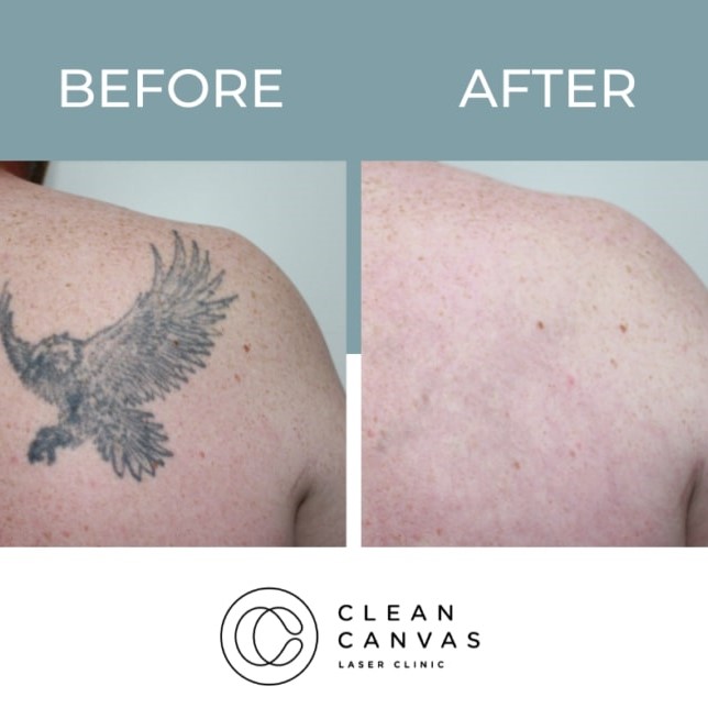Tattoo Removal Before and After: What You Need to Know 27 Tattoo Removal Before and After: What You Need to Know