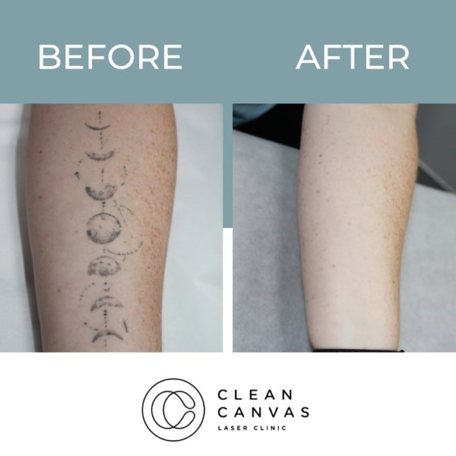 Tattoo Removal Before and After: What You Need to Know 31 Tattoo Removal Before and After: What You Need to Know