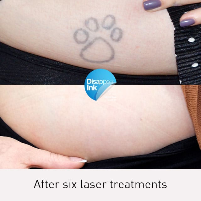 Tattoo Removal Before and After: What You Need to Know 6 Tattoo Removal Before and After: What You Need to Know