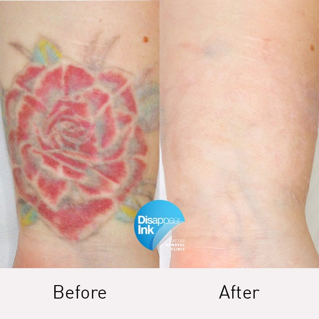 Tattoo Removal Before and After: What You Need to Know 7 Tattoo Removal Before and After: What You Need to Know